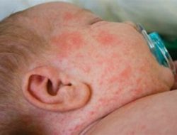 Kasus Campak di Kota Jambi Tembus 300